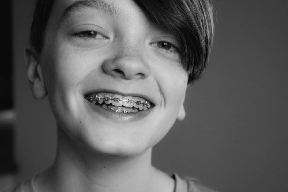 Tannregulering - En vei til et vakkert smil