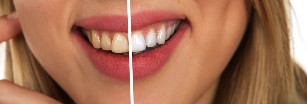 Tannbleking hos tannlegen | En trygg og effektiv måte å lyse opp smilet på